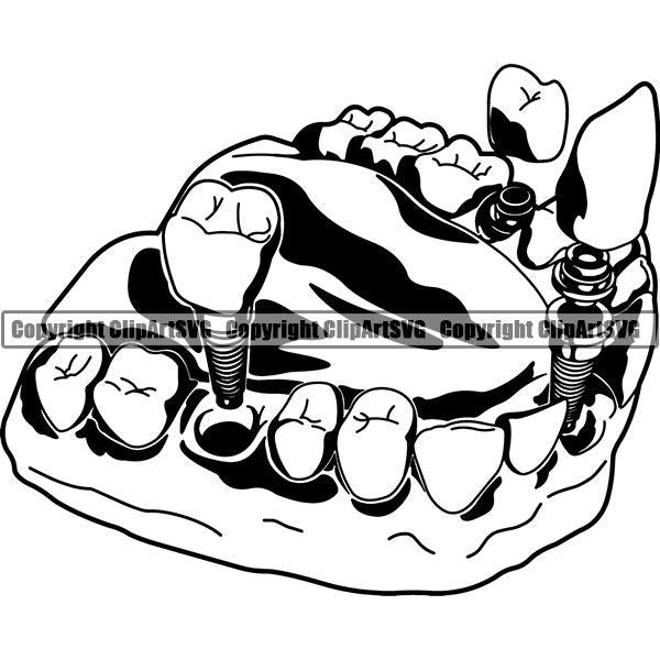 Dentist Dental Service Implants ClipArt SVG